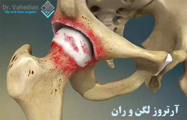آرتروز لگن و ران