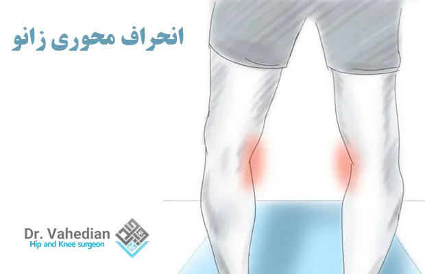انحراف محوری زانو