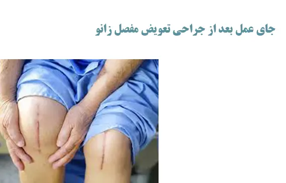 جای عمل بعد از جراحی تعویض مفصل زانو