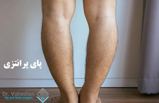 پای پرانتزی