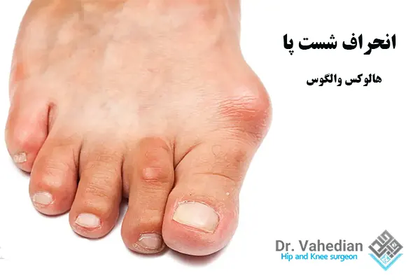 انحراف شست پا