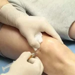 تزریق پی آر پی به زانو