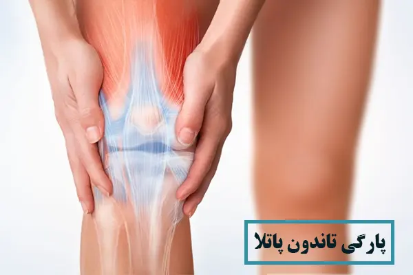 درمان پارگی تاندون پاتلا