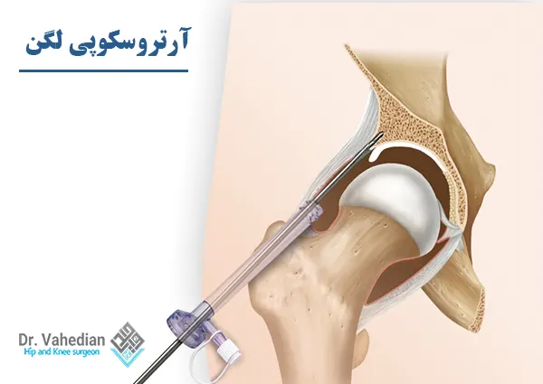 مراقبت آرتروسکوپی لگن