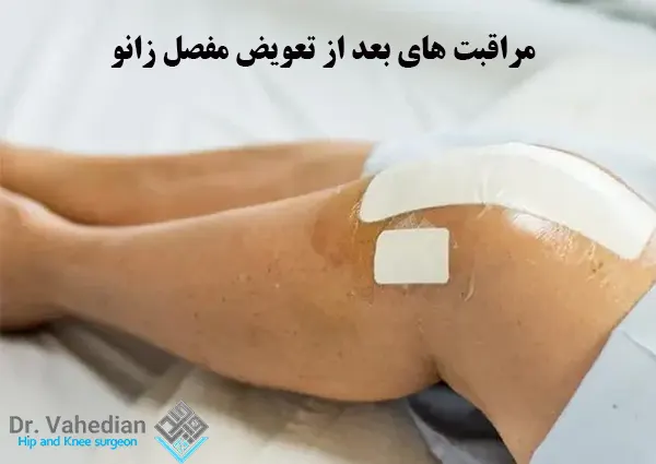 مراقبت های بعد از تعویض مفصل زانو