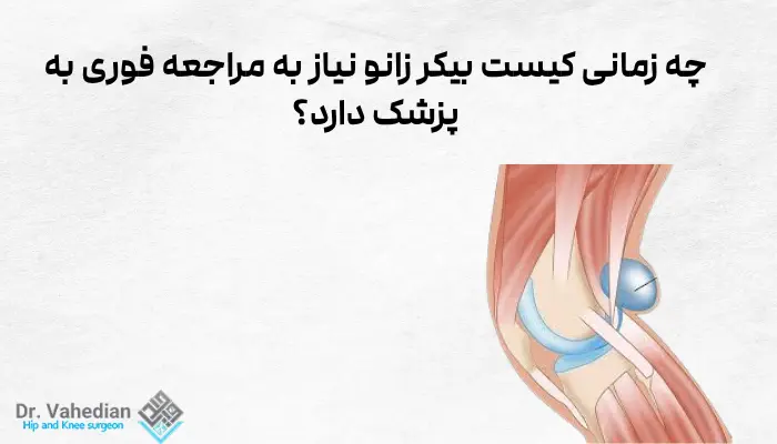 چه زمانی کیست بیکر زانو نیاز به مراجعه فوری به پزشک دارد؟