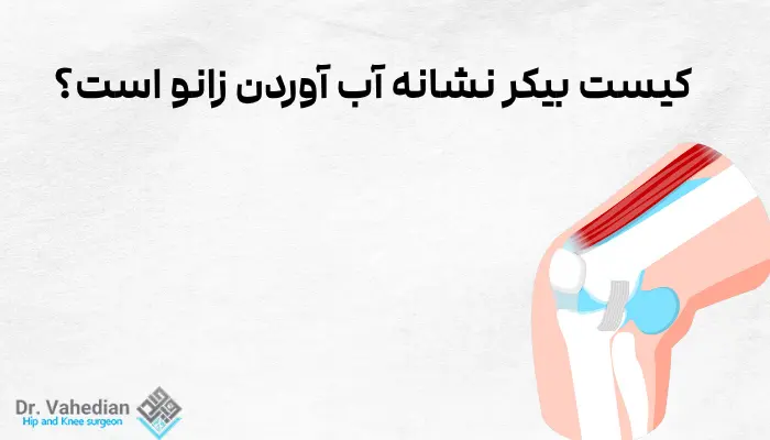 کیست بیکر نشانه آب آوردن زانو است؟