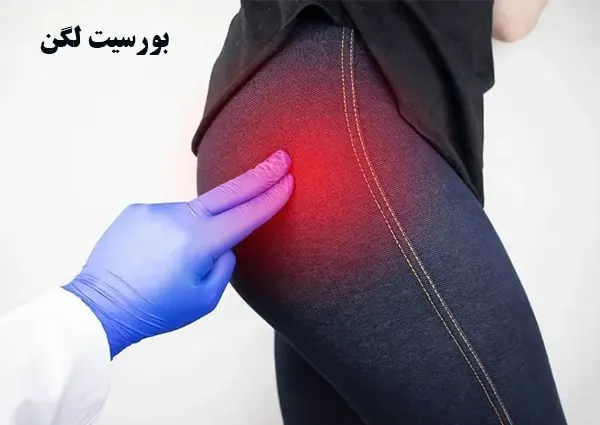 بورسیت و التهاب لگن