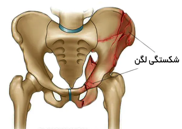 شکستگی لگن