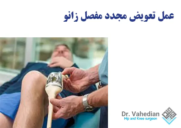 عمل تعویض مجدد مفصل زانو