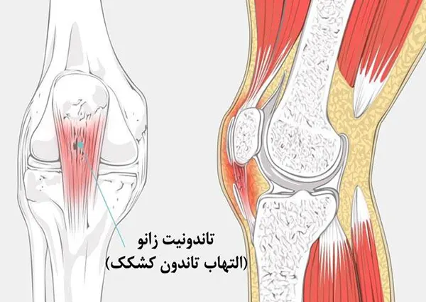 التهاب تاندون کشکک