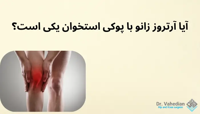 آیا آرتروز زانو با پوکی استخوان یکی است؟