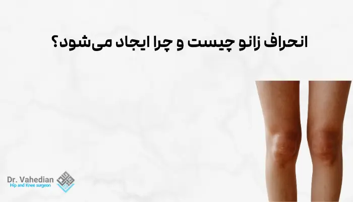 انحراف زانو چیست و چرا ایجاد میشود؟