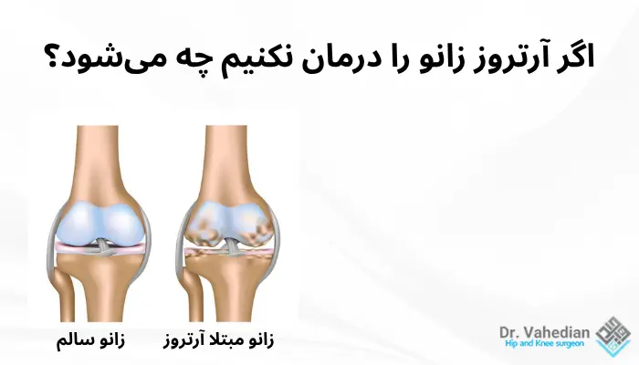 اگر آرتروز زانو را درمان نکنیم چه میشود؟