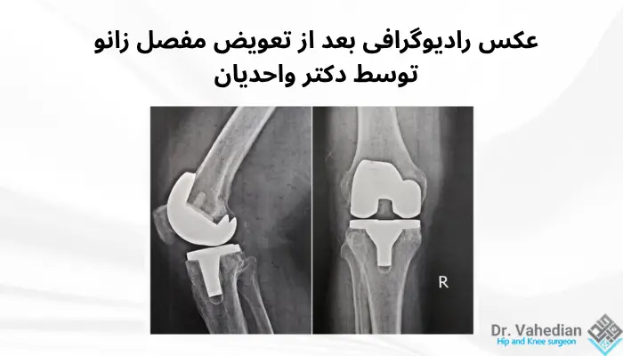 عکس رادیوگرافی تعویض مفصل زانو عکس رادیوگرافی تعویض مفصل زانو