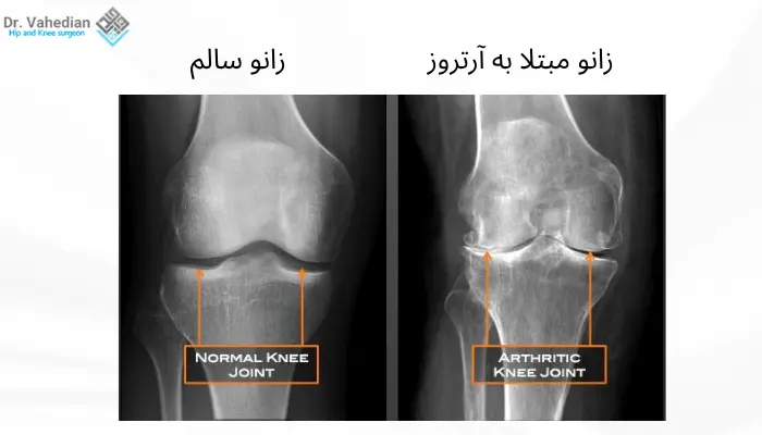 عکس قبل و بعد مبتلا به آرتروز