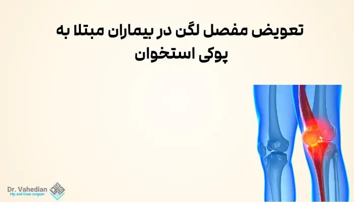 تعویض مفصل لگن در بیماران مبتلا به پوکی استخوان