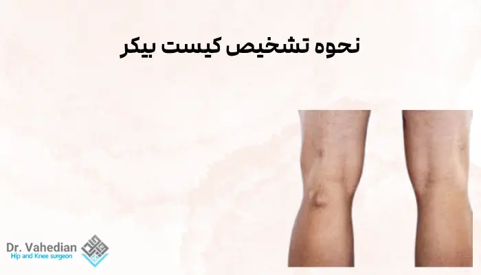 نحوه تشخیص کیست بیکر