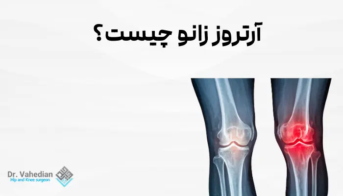 آرتروز زانو چیست؟